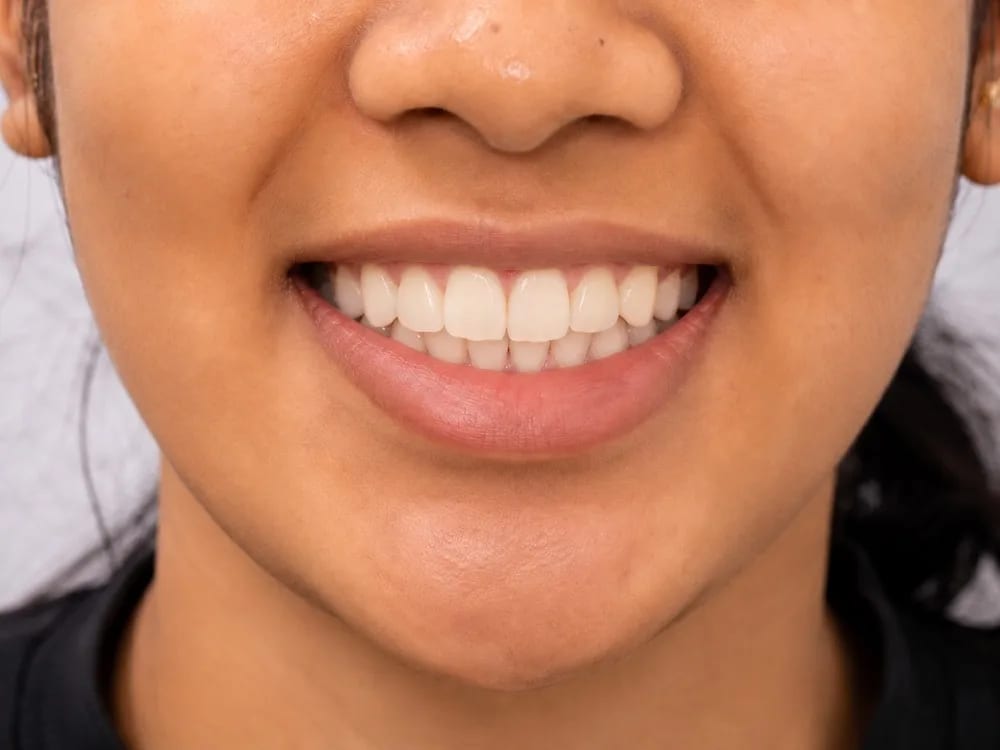 Braces Alignment — after treatment